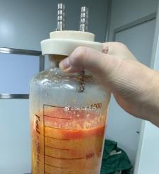 防城港水动力吸脂手术要做多久？